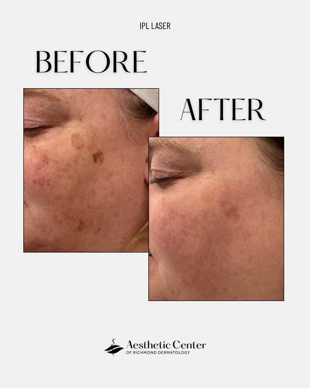 Say goodbye to stubborn sun spots and hello to clearer skin with our IPL laser treatment!

Using laser light energy to break up pigment below the surface, Melissa treated this patient to help them:
✨ Target skin discoloration
✨ Fade sun damage spots
✨ Even out skin tone

Call 804-285-2320 to book your appointment with Melissa or one of our other skilled medical aestheticians to achieve a brighter complexion!

#acordrva #rvaaestheticcenter #rvadermatology #IPLlaser #virginiaaesthetics